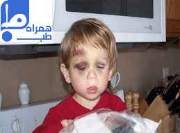 هموفیلی کودکان 